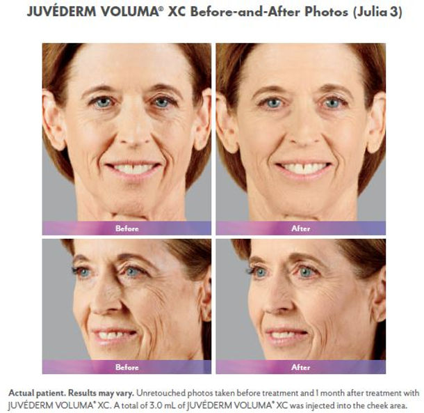 Juvaderm_VolumaXC_Julia3.JPG