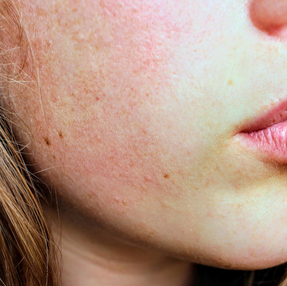 Ayurveda for Dry Skin: Balancing Vata