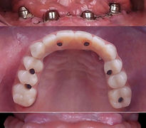 Prótesis dental completa y sus cuatro soportes de implantes, All-on-4