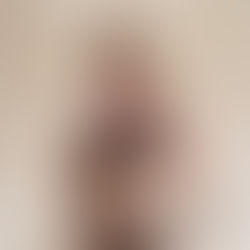 Laser Íntimo: seu aliado na menopausa cirúrgica