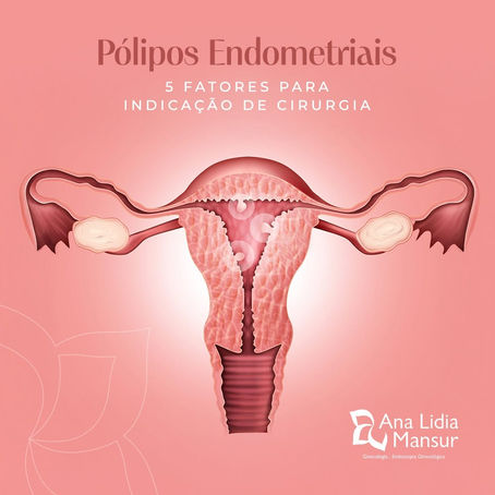 Pólipos Endometriais: 5 fatores para indicação de cirurgia!