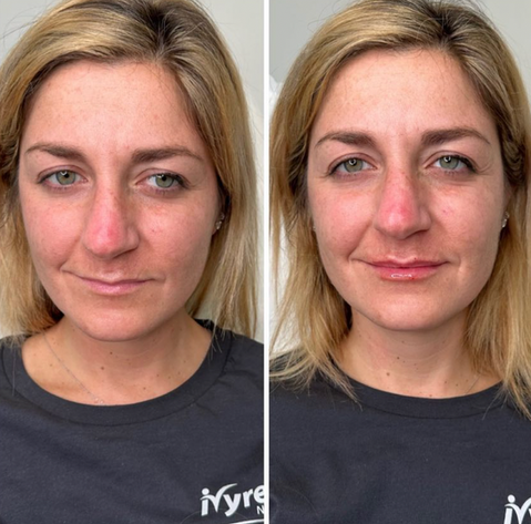 Lip filler injections