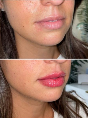 Award-Winning, Top Surgeon Injectors Best Filler for Lips, Facial Injections + Nose Filler