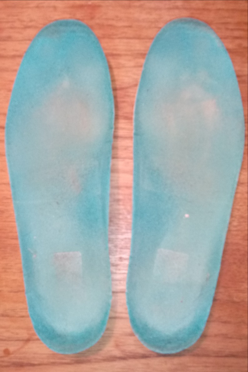 Insoles show high pressures in the central ball of foot area on the right but more medial ball of foot on the left.