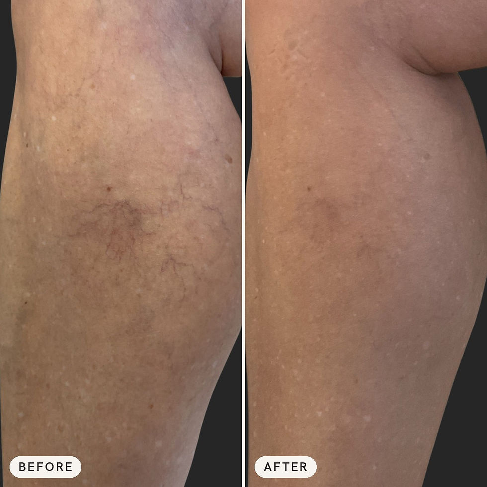 Before and after Aerolase Neo laser treatment of visible leg veins at Longevity Aesthetics