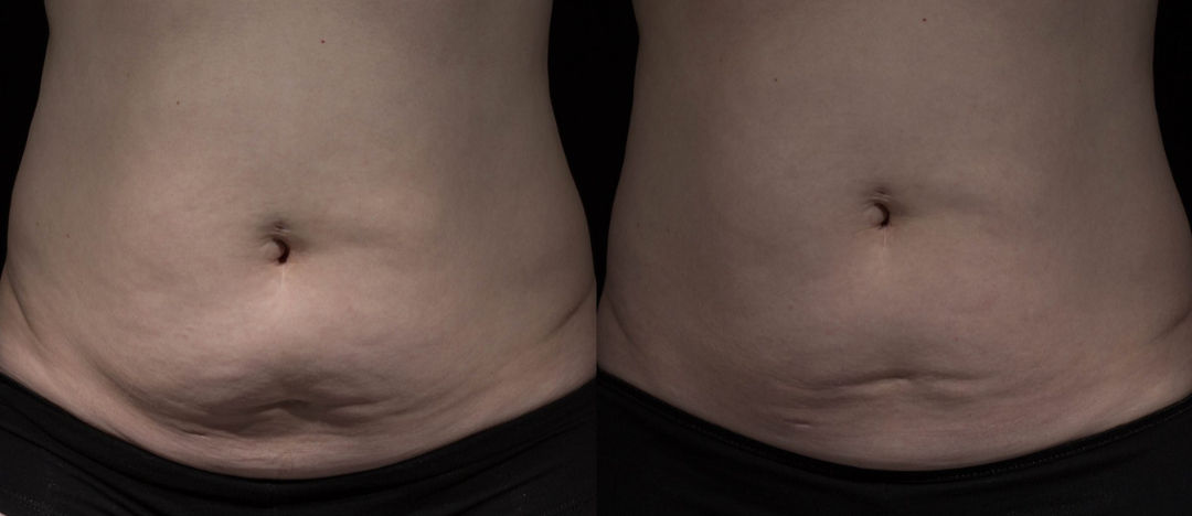 Tratamiento para flacidez en Barcelona