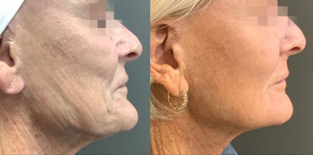 Lifting facial sin cirugía