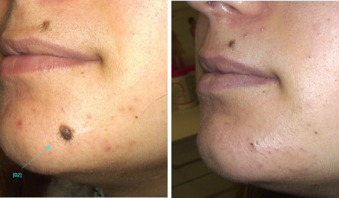 Como quitar lunares en Barcelona