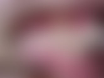 Crooked teeth treatment without braces