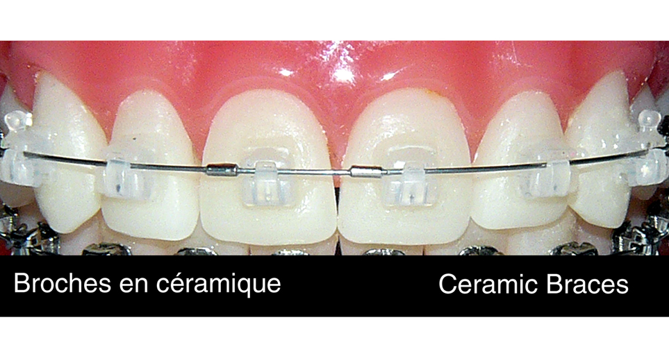 Orthodontic Retainers QUEBEC OrthoMontreal Inc 514 Montreal