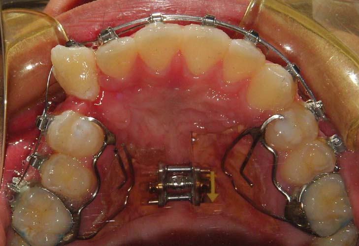 Orthodontic Retainers QUEBEC OrthoMontreal Inc 514 Montreal