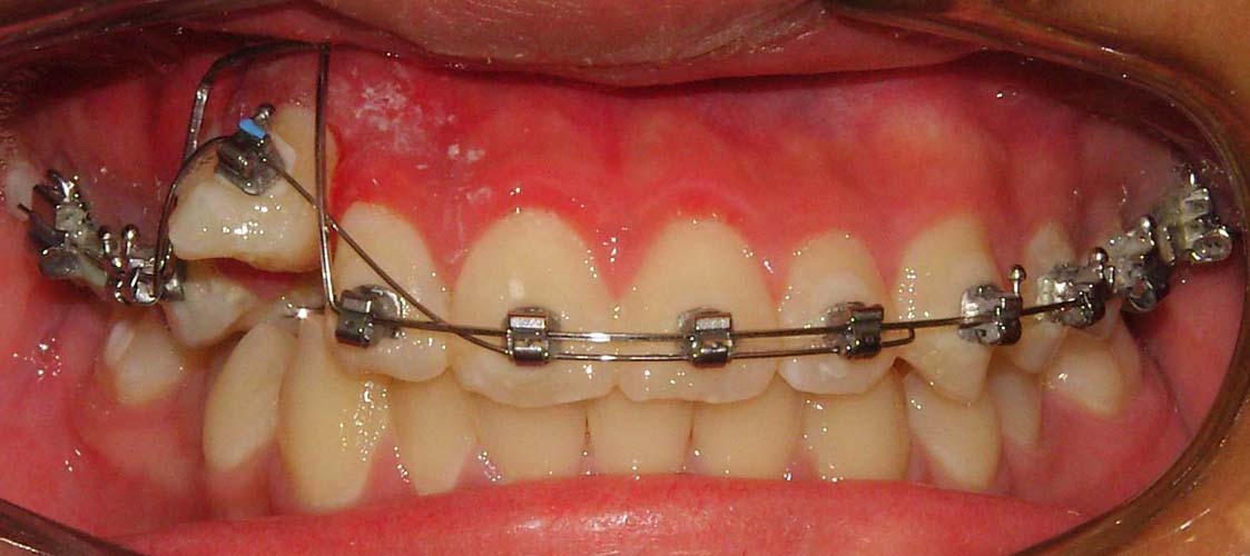 Orthodontic Retainers QUEBEC OrthoMontreal Inc 514 Montreal