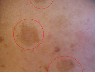 ฝ้า (Melasma) คืออะไร? สาเหตุ อาการ และวิธีรักษา