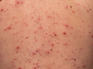 อีสุกอีใส (Chickenpox)
