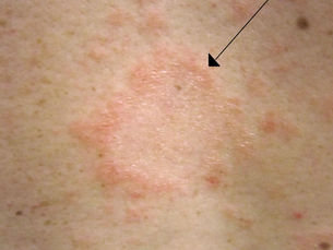 ปิติยาสิส โรซีอา (Pityriasis Rosea) — ผื่นลอกชั่วคราวที่หายเองได้