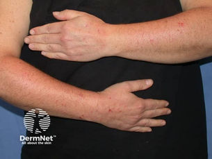 Insect bite skin reaction dermatitis