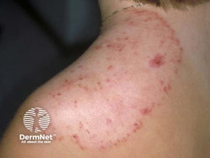 Fungal skin infection ringworm tinea corporis