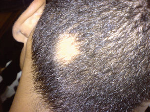 ผมร่วง (Alopecia) สาเหตุ ชนิด และวิธีรักษาผมร่วง