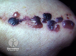 Bullous pemphigoid blisters