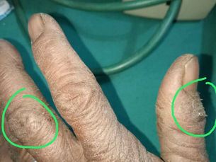 Chronic eczema dry skin dermatitis