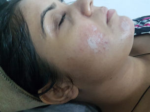 เคมีพีลลิ่ง (Chemical Peel): กรรมวิธีผลัดผิวด้วยกรดทางการแพทย์