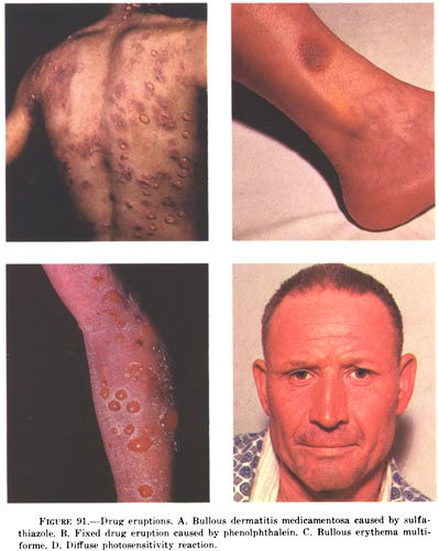 ผื่นแพ้ยา Drug Rash ผื่นแดงบนผิวหนัง