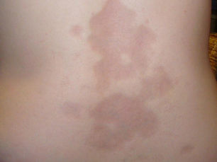 Morphea (Localized Scleroderma): ผิวหนังแข็งเฉพาะที่ต่างจาก Scleroderma ทั่วไป