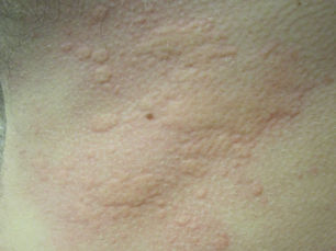 ลมพิษ (Urticaria) คืออะไร? สาเหตุ อาการ และวิธีรักษา