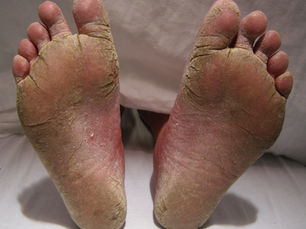 เชื้อราที่เท้า (Tinea Pedis) — อาการ สาเหตุ และการรักษาอย่างถูกต้อง