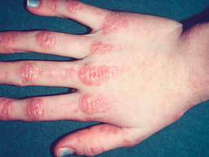 Dermatomyositis skin rash heliotrope