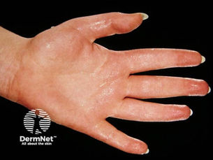 Plantar hyperhidrosis sweaty feet