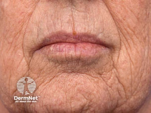 Photoaging sun damaged aging skin
