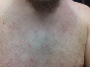 ผดร้อน (Miliaria) — ผื่นอากาศร้อน สาเหตุ และวิธีป้องกัน