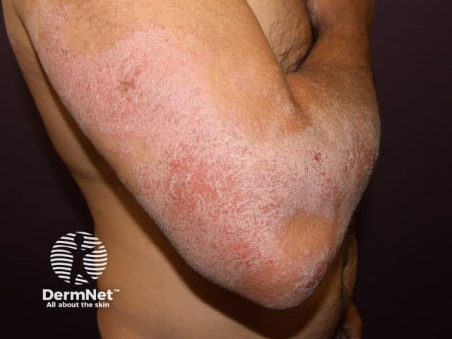 Atopic dermatitis eczema itchy skin inflammation