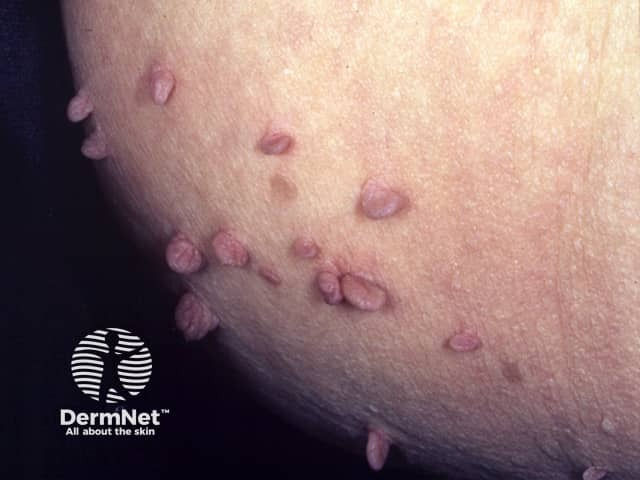 Skin tag fibroma benign lesion neck