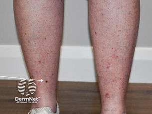Solar lentigo age spots sun freckles