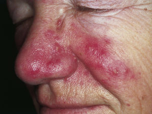 Rosacea and facial telangiectasia