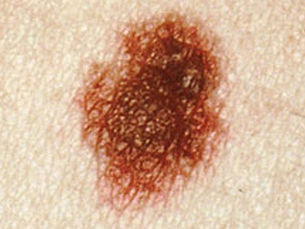 ไฝและกระ (Moles & Freckles) — ความแตกต่าง อันตราย และวิธีดูแลอย่างถูกต้อง