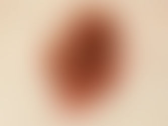 ไฝและกระ (Moles & Freckles) — ความแตกต่าง อันตราย และวิธีดูแลอย่างถูกต้อง