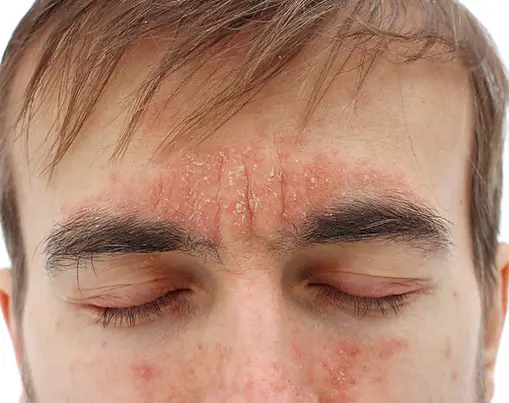 เซ็บเดิร์ม - Seborrheric dermatitis