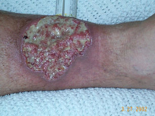 Pyoderma Gangrenosum: แผลเน่าเรื้อรังที่ไม่ได้เกิดจากเชื้อโรค