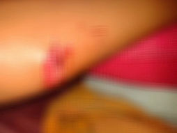 Pit bull solto ataca menino de 11 anos no Residencial Terra Bela