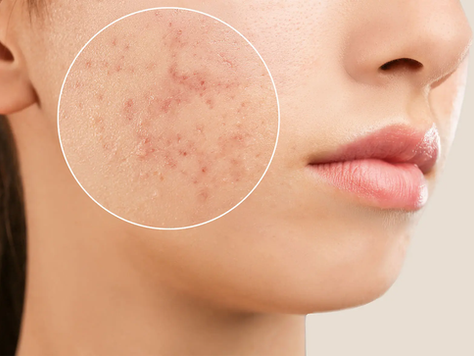 Astuces anti-acné