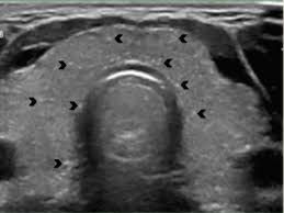 Carcinoma papilar tiroideo ecografía — nódulo hipoecoico microcalcificaciones punctatas | Dr. Segnini