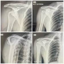 luxacion-anterior-hombro-radiografia-AP-axilar.jpg | Alt SEO: Luxación anterior glenohumeral en radiografía de hombro AP y axilar — posición subcoracoidea | Dr. Segnini