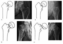 fractura-cadera-subcapital-clasificacion-garden-radiografia.jpg | Alt SEO: Fractura subcapital de cadera clasificación de Garden III en radiografía AP de pelvis | Dr. Segnini