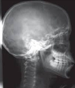silla-turca-erosion-hipertension-endocraneal-radiografia-lateral.jpg | Alt SEO: Erosión del dorso de la silla turca por hipertensión endocraneal crónica en radiografía lateral de cráneo | Dr. Segnini