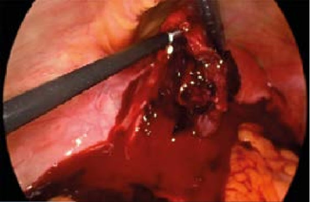 embarazo-ectopico-roto-hemoperitoneo-masivo.jpg | Alt: Embarazo ectópico roto ecografía — hemoperitoneo masivo líquido ecogénico Morrison | Dr. Segnini