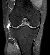 RM rodilla quiste Baker — sagital DP con supresón grasa meniscopatia degenerativa | Dr. Segnini