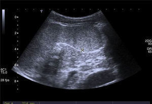 Linfoma esplénico ecografía — nódulos hipoecoicos múltiples esplenomegalia | Dr. Segnini